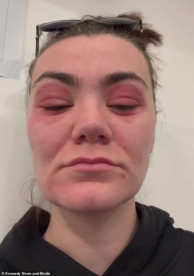 نيسا ماكجراتان تعاني من تورم وانتفاخ في عينيها، وتخشى الفتاة البالغة من العمر 27 عامًا أن يكون سبب ذلك هو استخدام منتج تجميل.