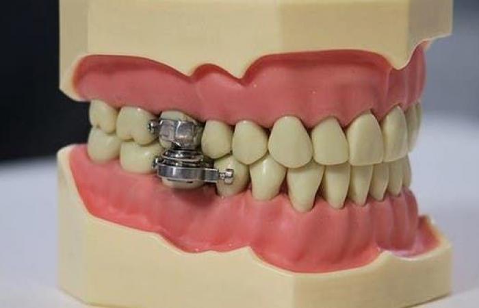"قفل الأسنان".. أغرب جهاز في العالم لإنقاص الوزن
