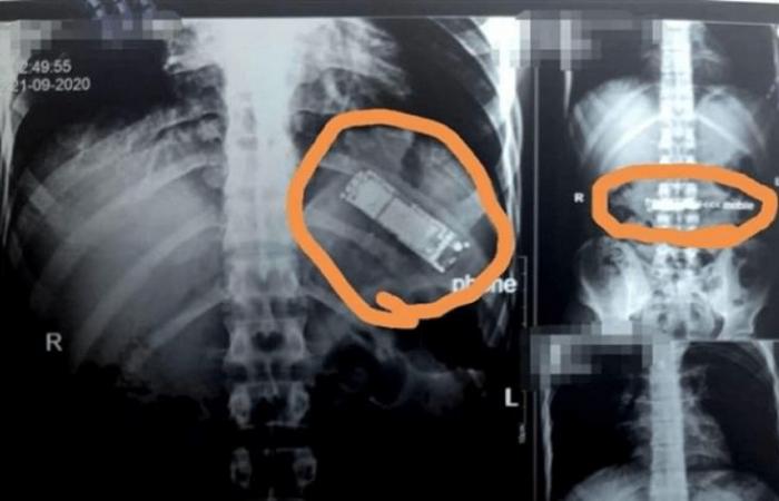 استخراج هاتف جوال من معدة مريض في مصر