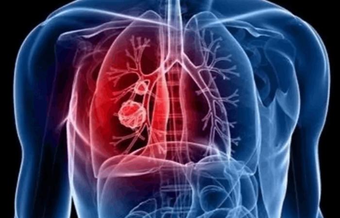 "قاتل خفي" يسبب سرطانات الرئة لغير المدخنين.. دراسة تكشف