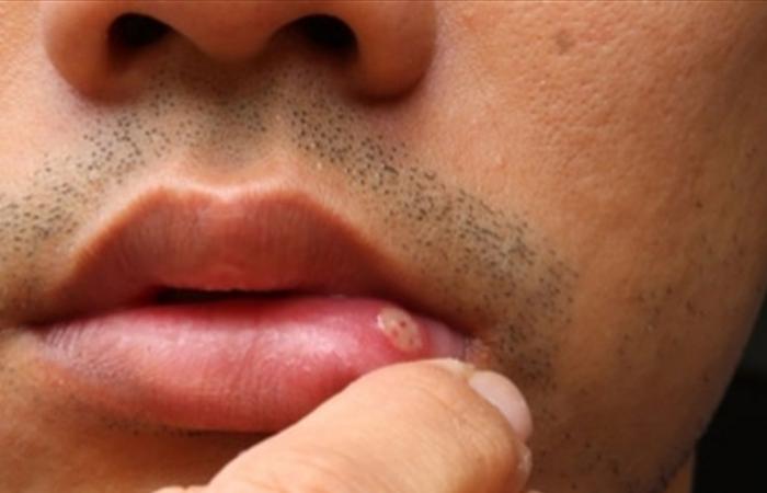 أمراض يمكن اكتشافها من خلال بعض العلامات في الفم... ما هي؟