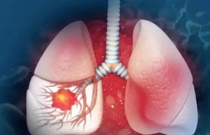 4 علامات تحذيرية لسرطان الرئتين تظهر في الصباح