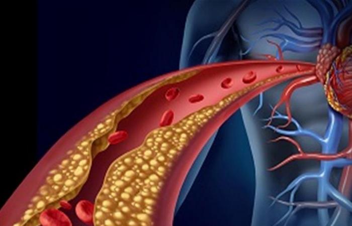 عقار ضد السرطان يبطئ تطوّر تصلب الشرايين