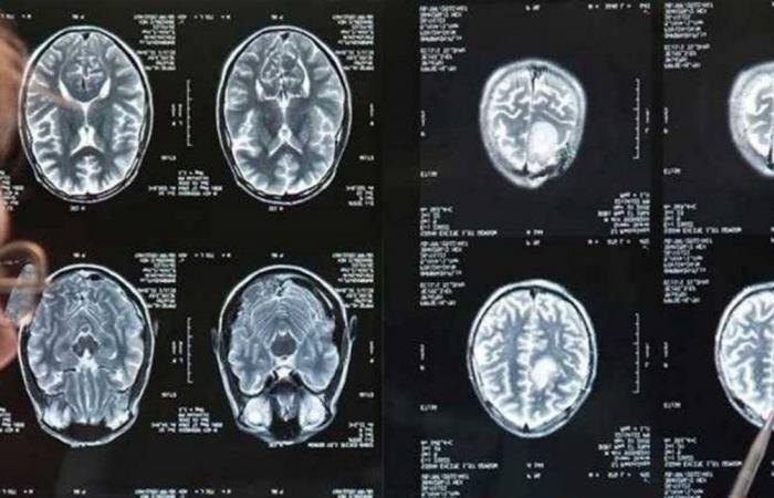 أعراض ورم الدماغ وعلاماته التحذيرية