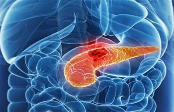 اكتشاف مهم قد يساعد في علاج سرطان البنكرياس