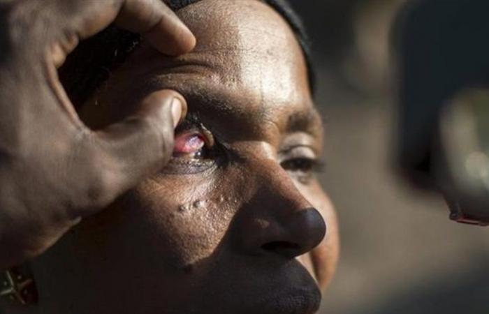 "العمى النهري".. مرض خطير ينتشر في هذه الدول!