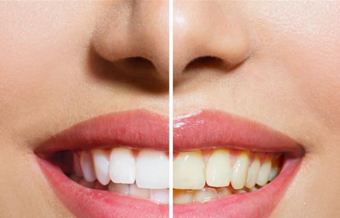 من لقمة واحدة إلى تسوّس سريع… ماذا يفعل السكر بأسنانك؟