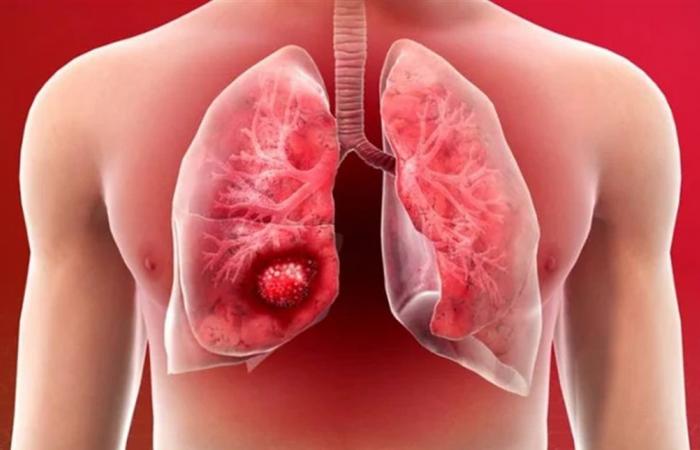 صلة خطيرة بين النظام الغذائي الحديث وسرطان الرئة… دراسة حديثة تكشفها!