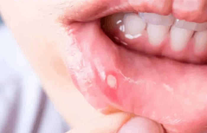 "تقرّحات الفم".. أطعمة تزيد الألم وأخرى ألطف على الجرح