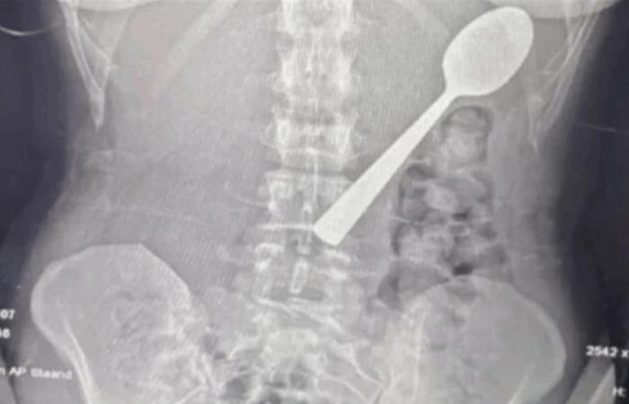 بسبب قفزة كلب.. شابة تبتلع ملعقة طولها 17 سنتيمتراً