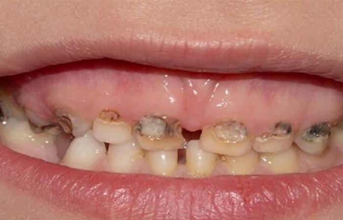 كيف يؤثر التدخين السلبي على صحة الفم لدى الأطفال؟