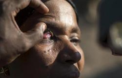 "العمى النهري".. مرض خطير ينتشر في هذه الدول!