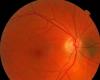 علماء يبتكرون إبرة مجهرية للعين 'ذاتية التوصيل'