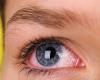 هذا ما يكشفه احمرار العين عن صحتك